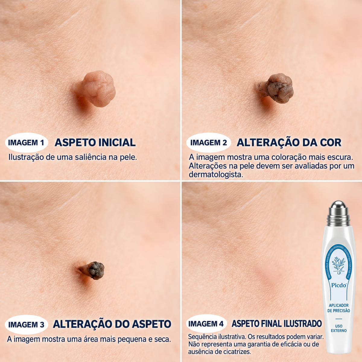 💖💖 𝐏i𝐜𝐝o® Eliminador de Marcas e Manchas em 7 Dias (Roll-on Sem Dor e Sem Cicatrizes)