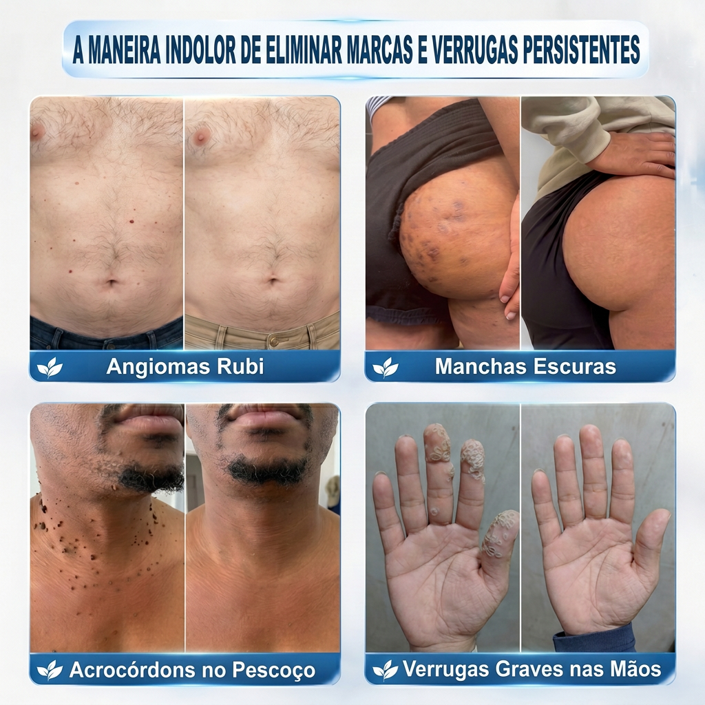 💖💖 𝐏i𝐜𝐝o® Eliminador de Marcas e Manchas em 7 Dias (Roll-on Sem Dor e Sem Cicatrizes)