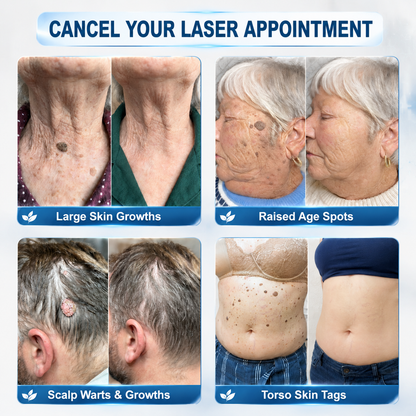 💖 𝐏i𝐜𝐝o® Eliminador de Marcas e Manchas em 7 Dias (Roll-on Sem Dor e Sem Cicatrizes)