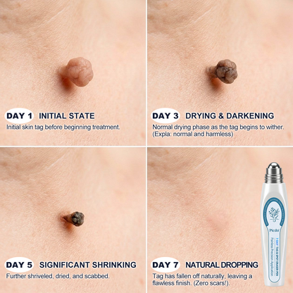 💖 𝐏i𝐜𝐝o® Eliminador de Marcas e Manchas em 7 Dias (Roll-on Sem Dor e Sem Cicatrizes)